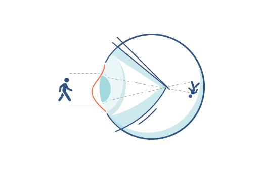 Ilustración de un ojo con astigmatismo