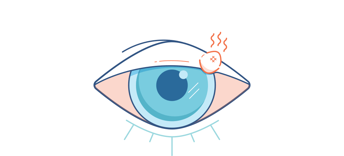 Ilustración de un ojo rojo dolorido con un orzuelo.